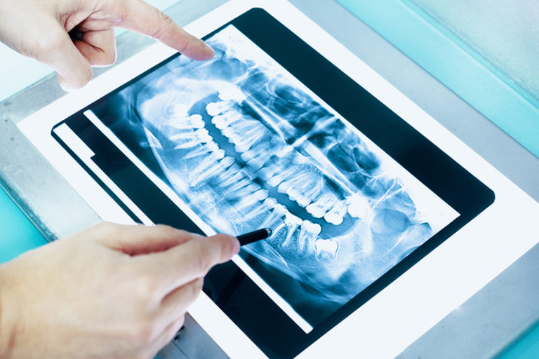 Dental XRays & Radiation Exposure A Better Smile Family Dentistry